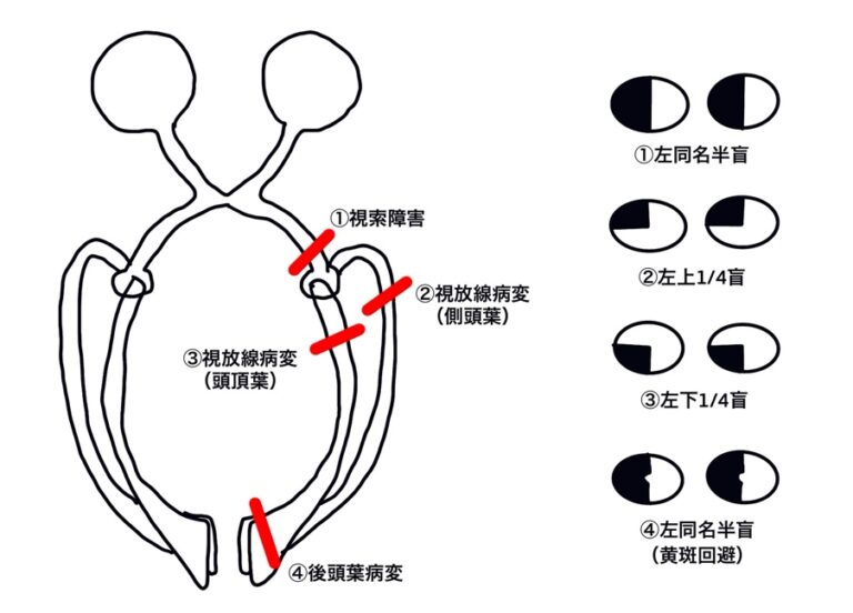 視索が障害されたときの視野欠損
