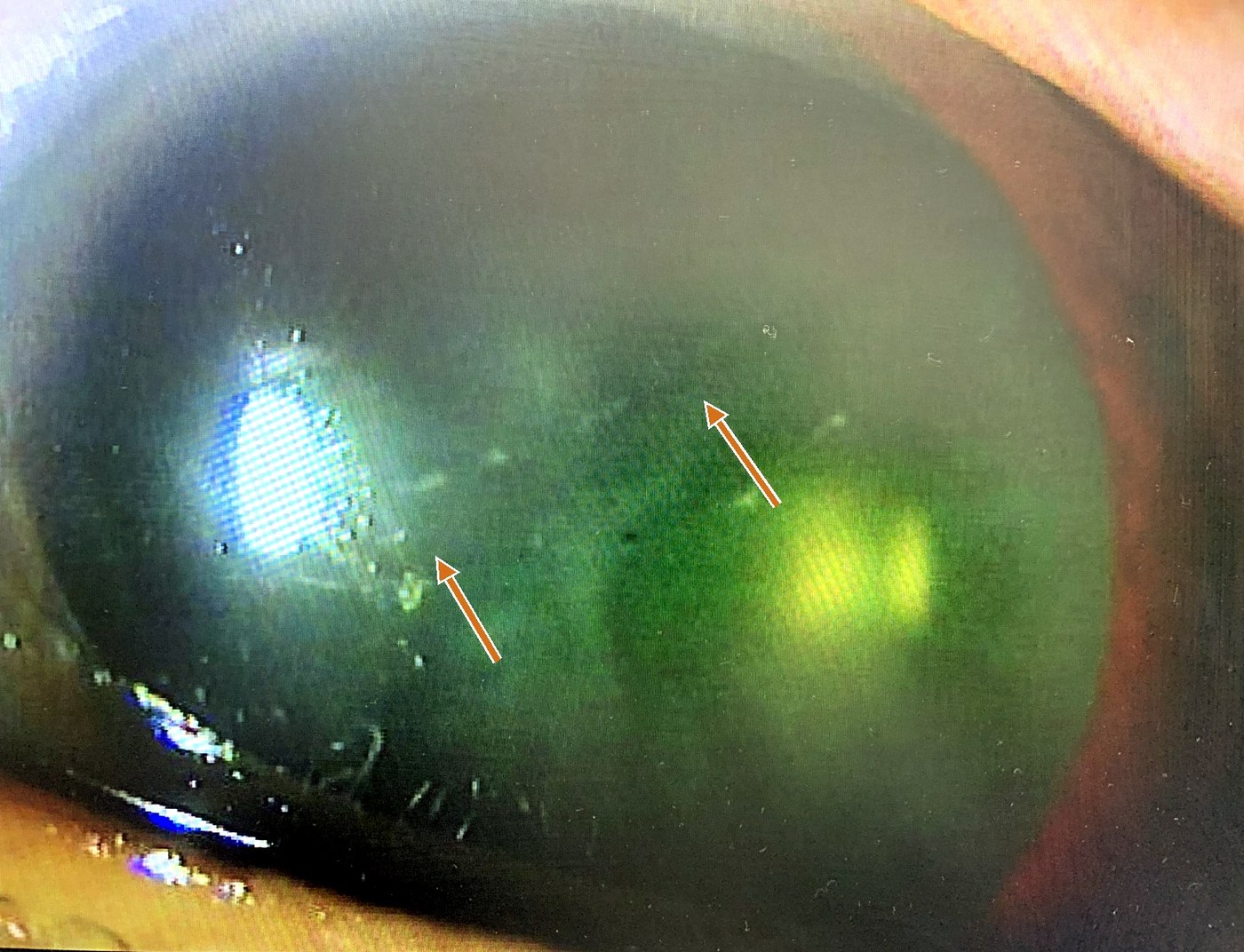 posterior corneal vesicle（細隙灯）