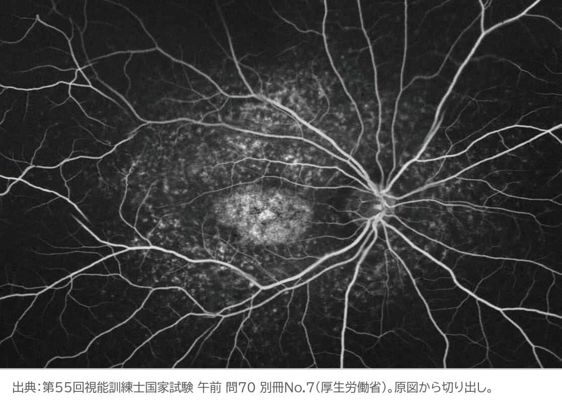 スタルガルト病の9歳男児のフルオレセイン蛍光眼底造影。背景が暗く網膜血管が浮き上がるdark choroid